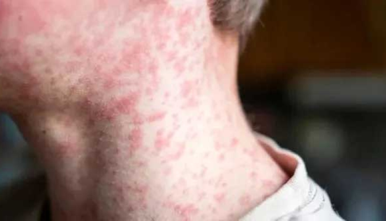 Confirman en la Ciudad el primer caso de sarampión en Argentina en 2026