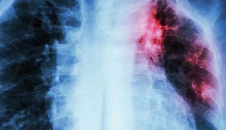 El histórico avance de científicos de la UBA que busca cambiar para siempre el tratamiento de la tuberculosis