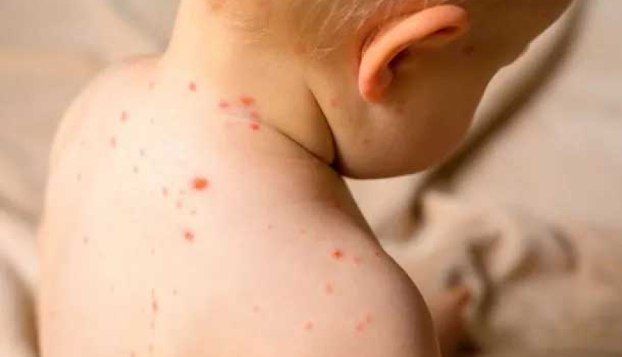 El Ministerio de Salud detectó un caso de sarampión en Entre Ríos y activó una alerta nacional