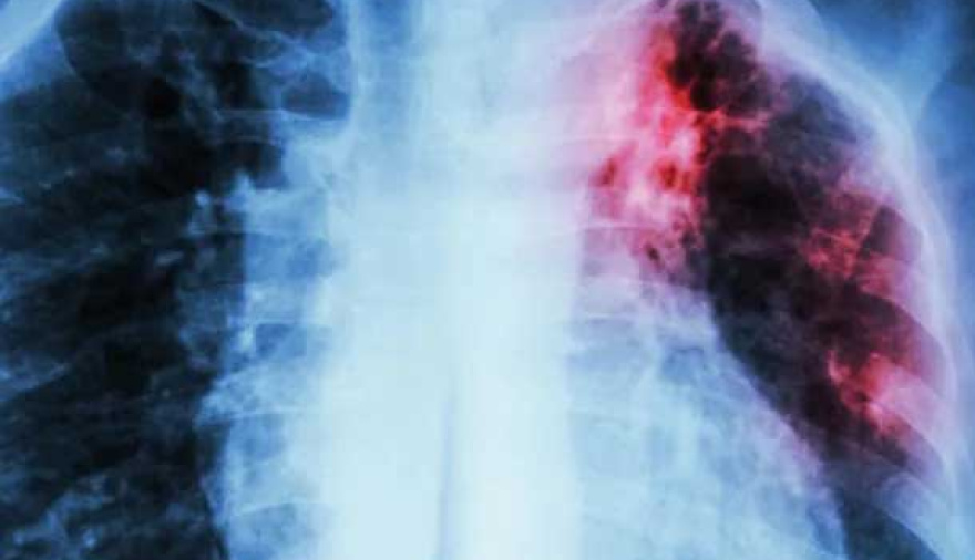 El histórico avance de científicos de la UBA que busca cambiar para siempre el tratamiento de la tuberculosis