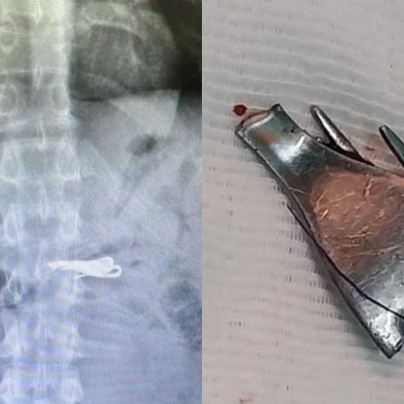 Un preso de alto perfil se tragó un tenedor en la cárcel y terminó internado bajo estricta custodia